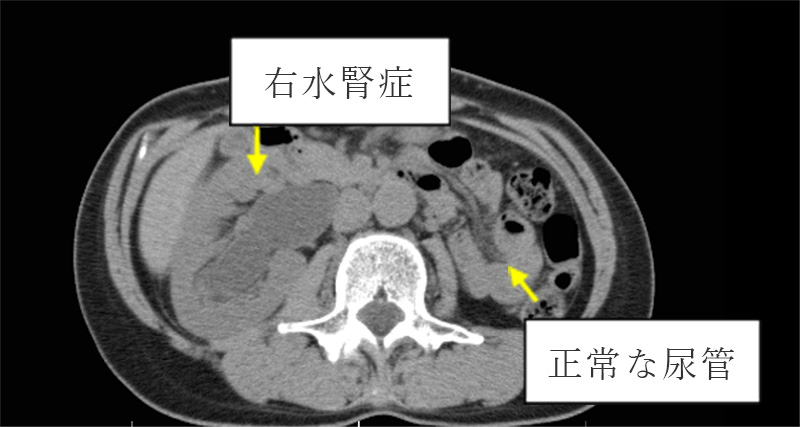 右水腎症と正常な尿管